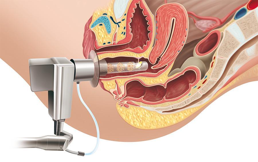 لیزر CO2 Intermedic دست دو/مدینیوم