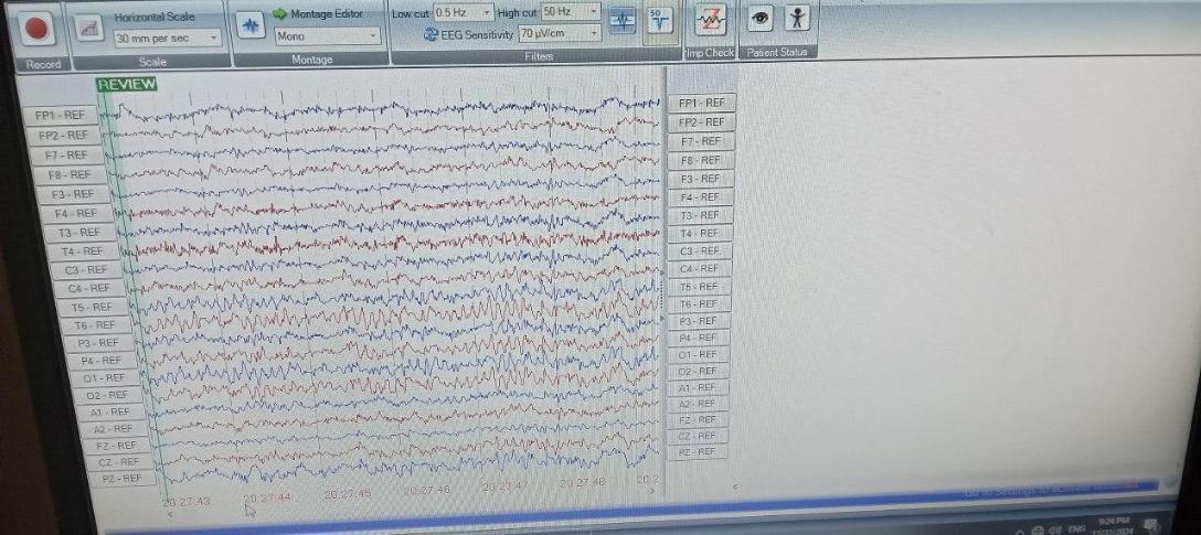 نوار مغز_EEGدست دو/مدینیوم