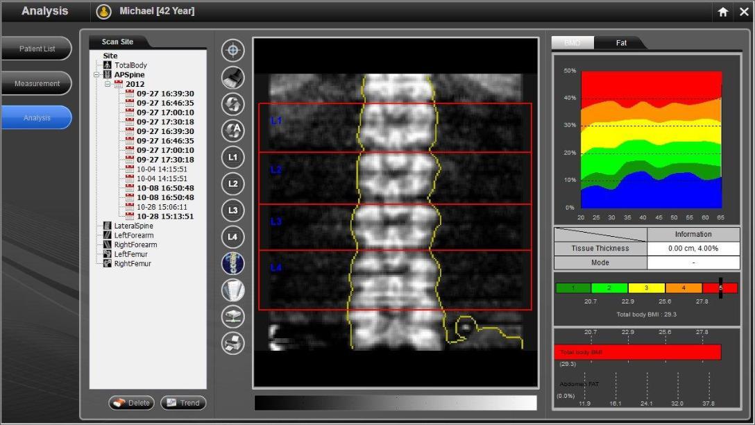 دستگاه تراکم استخوان مدل PRIMUS برند Osteosys کره جنوبینو/مدینیوم
