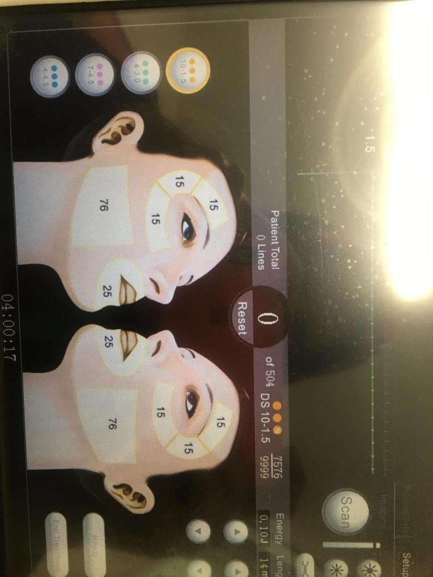 دستگاه هایفو سه بعدی الترادست دو/مدینیوم