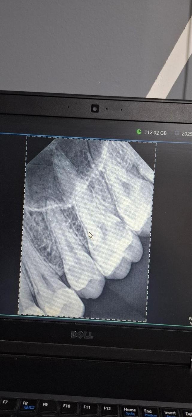 رادیوگرافی و سنسور RVGدست دو/مدینیوم
