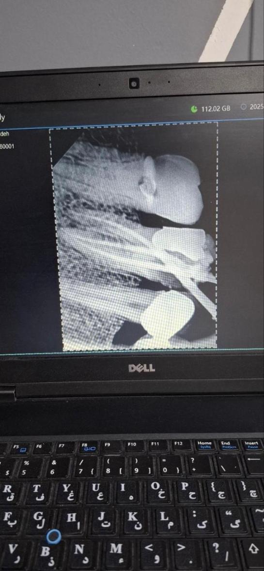 رادیوگرافی و سنسور RVGدست دو/مدینیوم