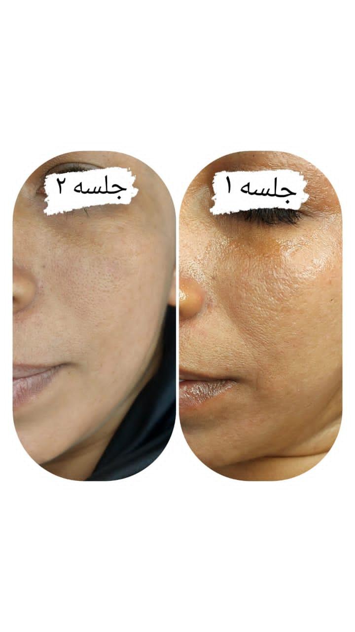 دستگاه پلاسما فرکشنال اسپارک المانینو/مدینیوم