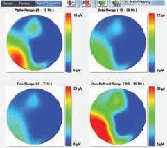 دستگاه نوار مغز EEGنو/مدینیوم