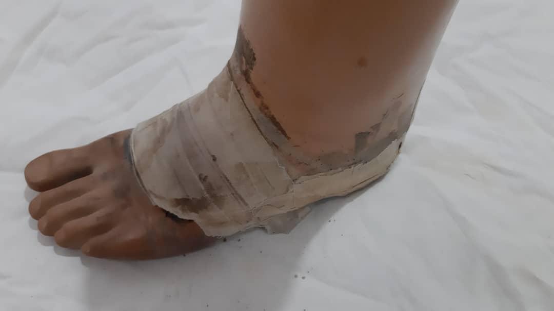 پا مصنوعینو/مدینیوم